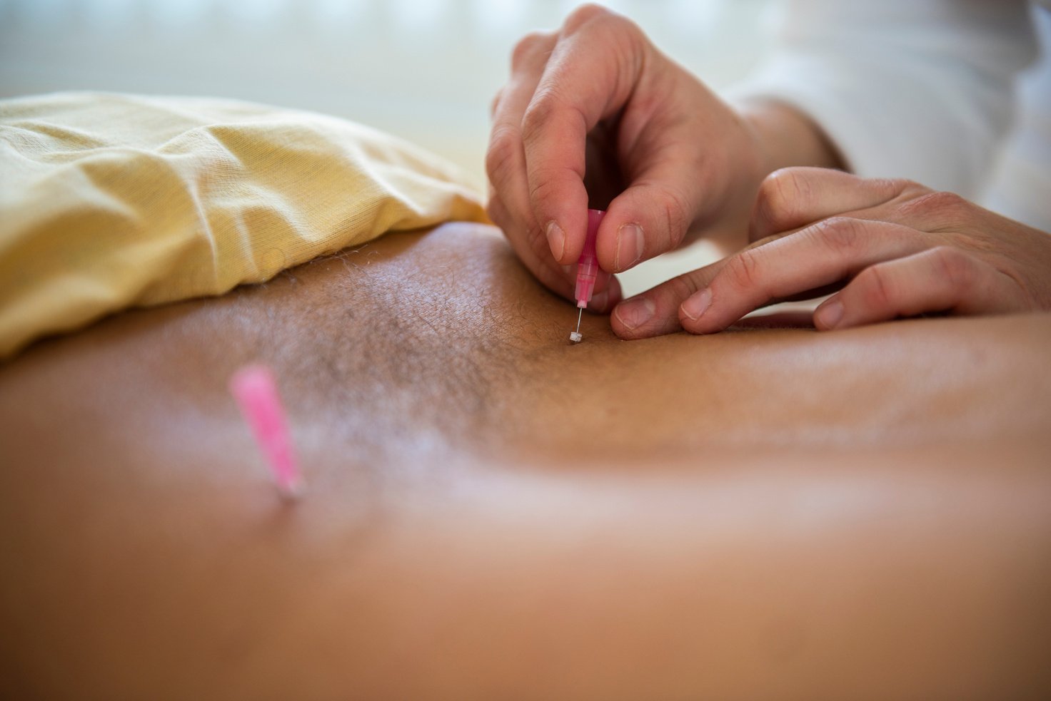 detail of accupuncture close up detail of hands appling acupuncture needles